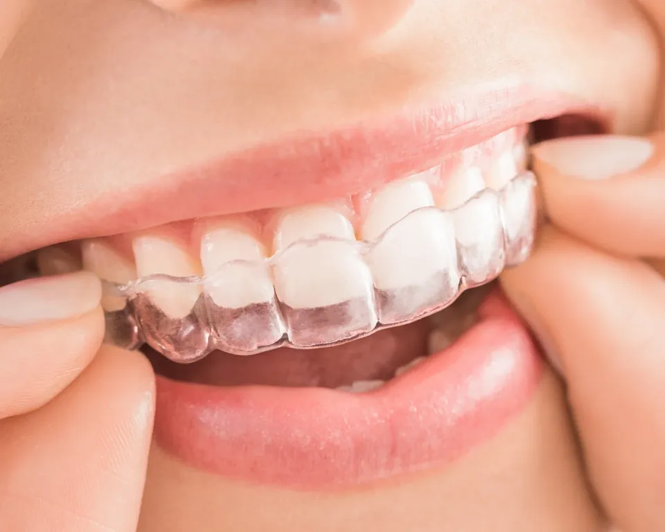 Invisalign